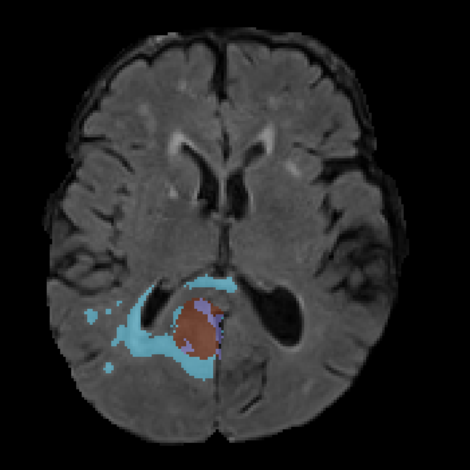 Example FLAIR MRI sequence
