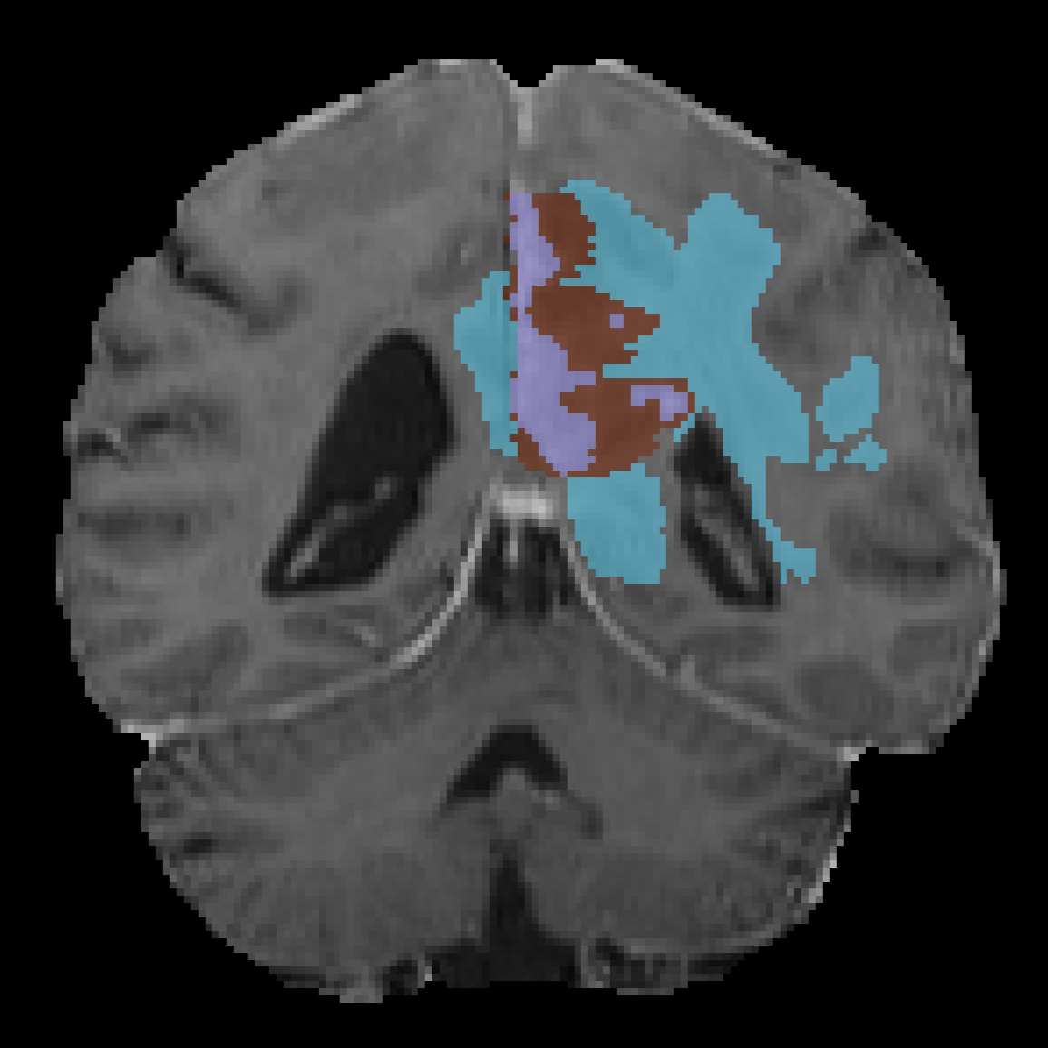 Example T1CE MRI sequence