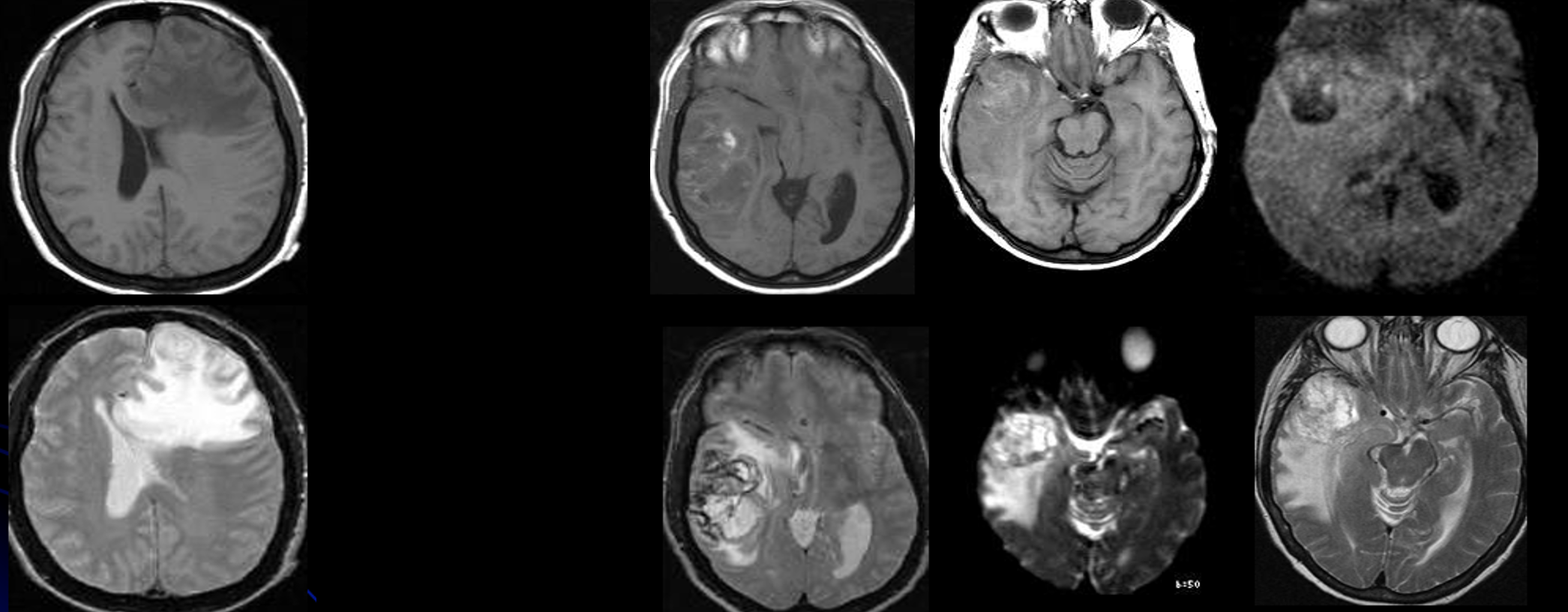 F012 – Intratumoral Hemorrhage