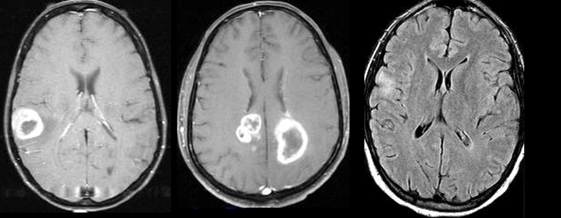 F019 – Type of Lesion