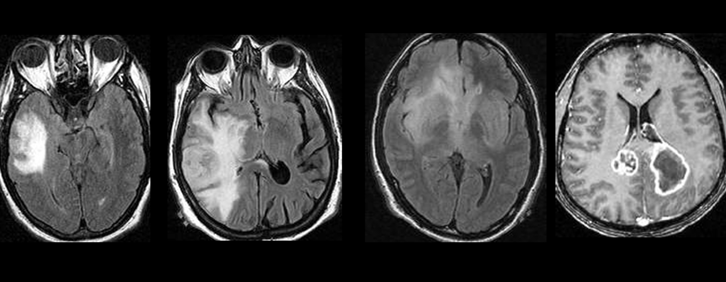 F020 – Ependymal Invasion